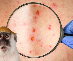 Viruela del mono: Alertan 800 casos en 27 países