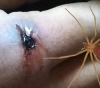 Hombre muere tras la picadura de una araña.