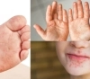 Enfermedad de mano, pie y boca: síntomas, tratamiento y prevención.