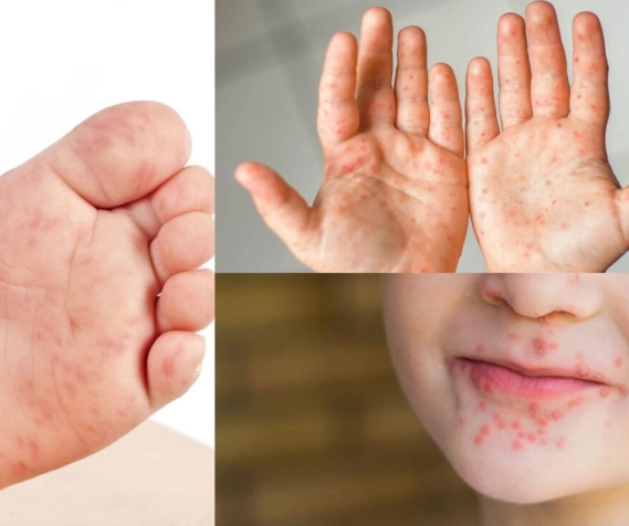 Enfermedad de mano, pie y boca: síntomas, tratamiento y prevención.